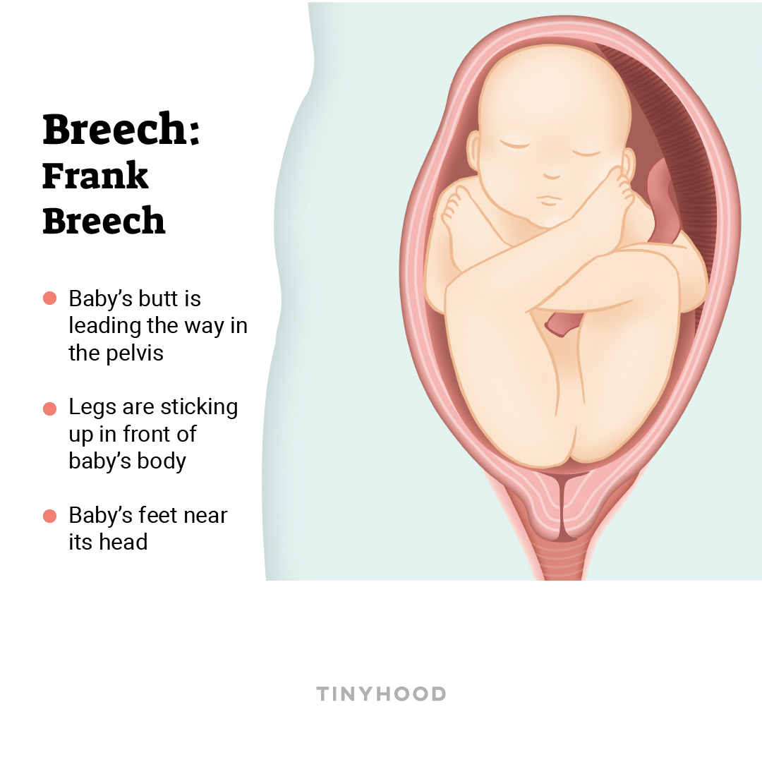 breech baby positions