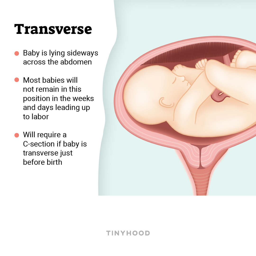 Can You Get Your Transverse Baby to Turn?