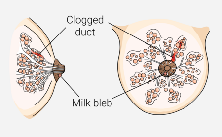 Diagram of a clogged milk duct